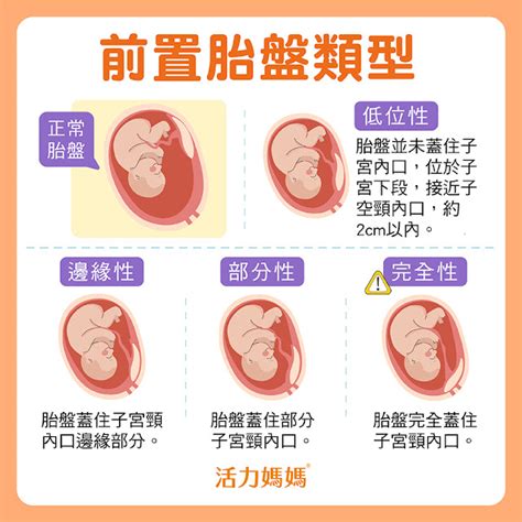 前置胎盤症狀 孕婦圖